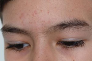 Super Efektif! 5 Tips Skincare untuk Fungal Acne Kamu